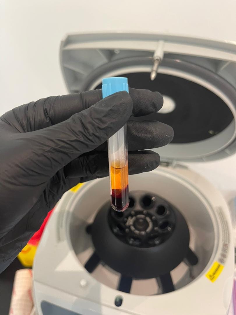 Plasma Riche en Plaquettes (PRP)